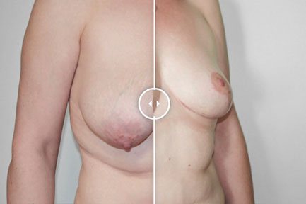 Modelace prsou